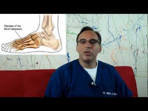 how to treat 5th metatarsal stress fracture