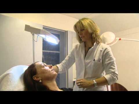 Acnelittekens verwijderen met de Mixto Co2 laser van Bergman Clinics 