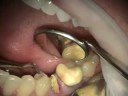 Immediate Implant Placement