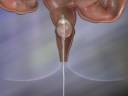 3D medical animation diagnosis of colon cancer by GI View