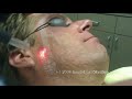 Active FX Laser Acne Scar Removal Active FX Laser Acne Scar Removal