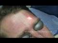 Active FX Laser Acne Scar Removal