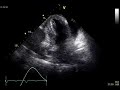 pericardial effusion RA collapse