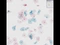 Histopathology Cervix--Low grade squamous intraepithelial le