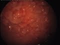 Tubercular nodular pleuritis