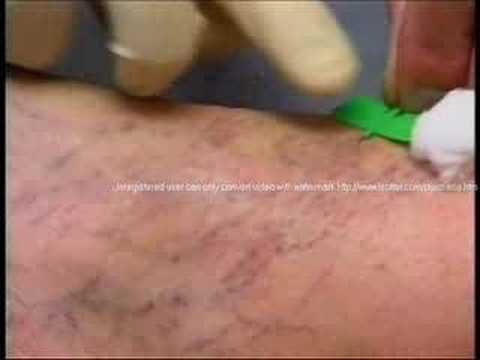 Philadelphia Vascular Surgeon Spider ...