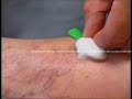 Philadelphia Vascular Surgeon Spider Veins Dr Kirksey