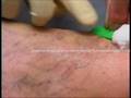 Philadelphia Vascular Surgeon Spider Veins Dr Kirksey
