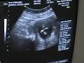 Nuestro Beb� - Wittwer-Legue - semana 13