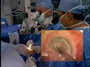 Intralase lamellar keratoplasty