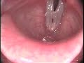 Mucosal swellings (polyps, nodules, capillary ectasias) come in many shapes and sizes. Depending on their size, the pitch and volume, they can have various effects on the voice.