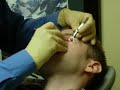 Chalazion removal, my 2nd cosmetic surgery, LOL