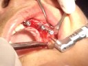 Implante Dentário (ATAS Odontologia) 2 Implante Dentário (ATAS Odontologia) 2