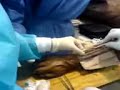 diseccion antebrazo posterior