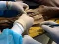 diseccion antebrazo posterior diseccion antebrazo posterior