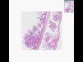 Histopathology Ovary--Serous cystadenoma