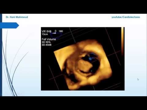 how to treat lv thrombus