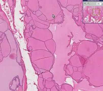 Histopathology Thyroid--Colloid goiter