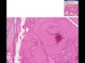 Histopathology Thyroid--Colloid goiter Histopathology Thyroid--Colloid goiter