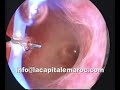 hysteroscopic treatment of intra uterine synechia