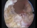 hysteroscopic treatment of intra uterine synechia