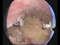 hysteroscopic treatment of intra uterine synechia