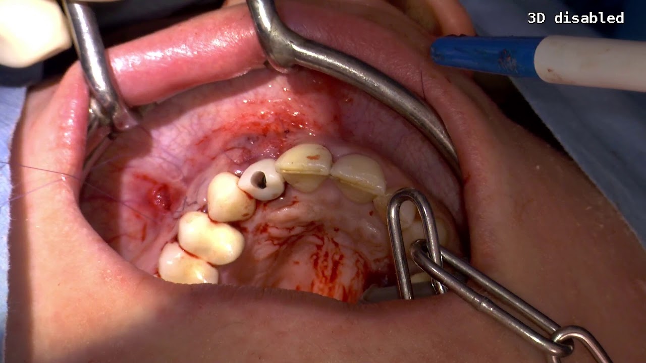 Live-OP Dr. Michael Berthold: Knochenaufbau mit der Schalentechnik