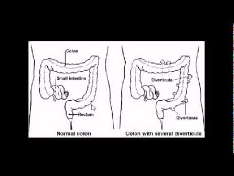 how to relieve diverticulitis