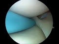 Arthroscopic Meniscal Repair - All-Inside Technique