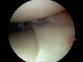 Arthroscopic Meniscal Repair - All-Inside Technique
