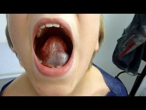 how to unclog salivary glands