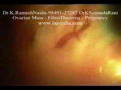 Laparoscopy Twisted Ovarian Cyst ...