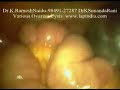 Laparoscopy Twisted Ovarian Cyst Full Video (Lap Ovary Cyst)
