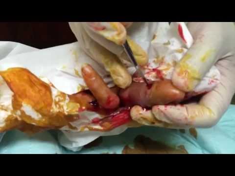 how to drain infected finger