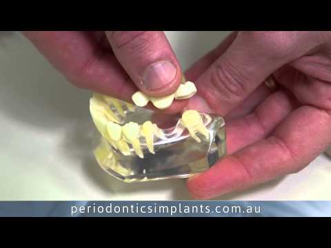 TOOTH!! - http://www.periodonticsimplants.com.au -- What are my options for replacing one missing tooth? - Periodontics & Implants Perth, WA There are basically 4 opti...