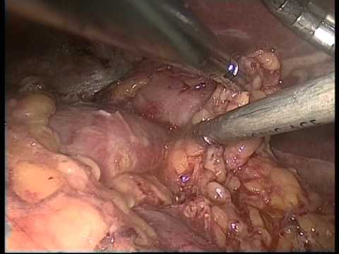 laparoscopic right partial nephrectomy
