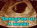 First Trimester Sonograms (Pregnancy Health Guru)
