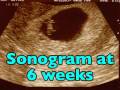 First Trimester Sonograms (Pregnancy Health Guru)
