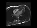 Cardiac MRI - Apical hypertrophy