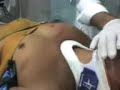 Trauma de torax grave Trauma de torax grave