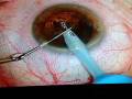 Staar Operatie Roosje - Eye Operation of my mother recorded Live