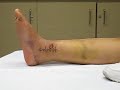 Fractured / Broken Ankle