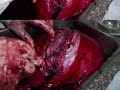large uterine mass