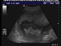 Ethan - Before He Was One & Two