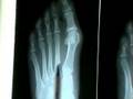 videos de Common Foot Problems