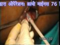 PILES in Hindi