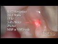 Class I Prep w/ Existing Composite - Lares PowerLase® All-Tissue Laser