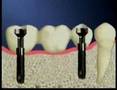 Dental Implants Bangkok  Thailand www thaiimplantcenter com