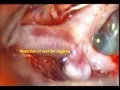 Brain aneurysm-internal carotid artery bifurcation aneurysm-dr suresh dugani/HUBLI/INDIA