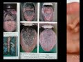 aids sida VIH HIV مرض نقص المناعة المكتسب مرض خبيث السيدا سيدا الايدز ايدز مريض المريض المرض عالمي العالمي تجنب العلاج مواد حادة خطير